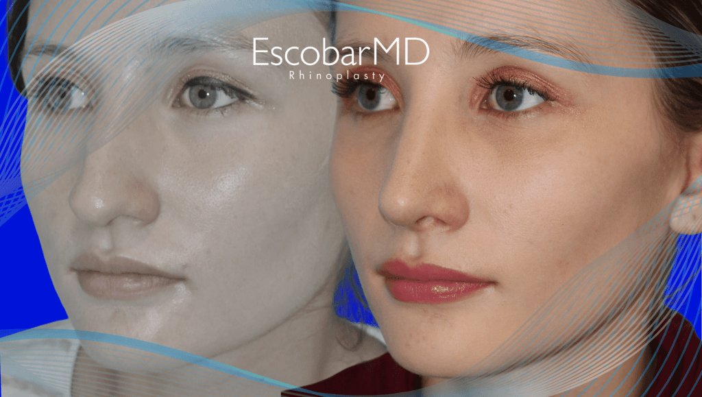 before after closed rhinoplasty Abu Dhabi Dubai