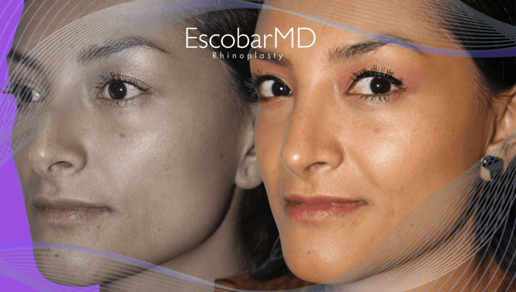 closed rhinoplasty before after Abu Dhabi Dubai