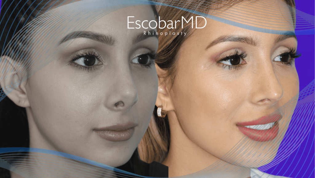 revision rhinoplasty Abu Dhabi Dubai