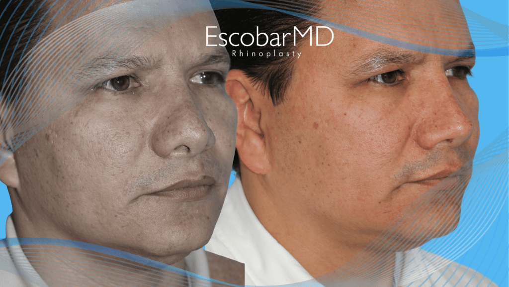 before after rhinoplasty in men Abu Dhabi Dubai